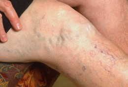 varicose veins